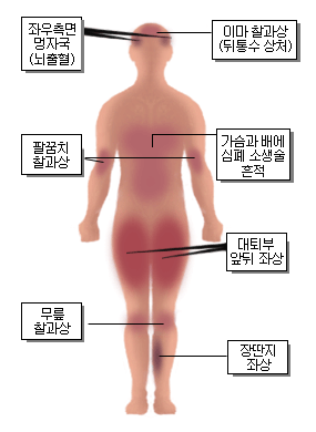 국과수가 밝힌 조씨의 사망 원인. 전신에 걸쳐 폭행당한 흔적이 남아 있다. 